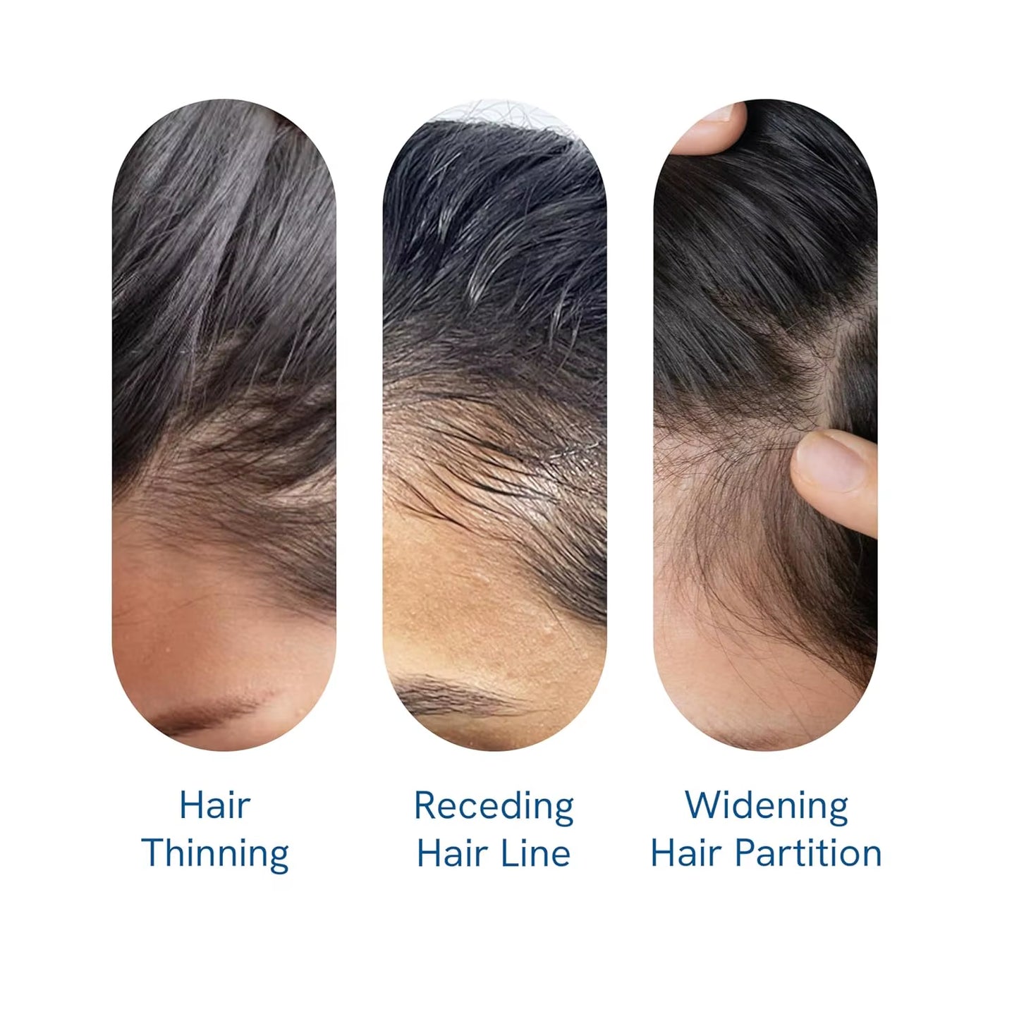 Be Bodywise Rosemary Hair Growth Serum Roll Dht-Blocking Scalp Serum Boosts Oxygen Flow, Reduces Hair Fall Paraben/Sulfate-Free